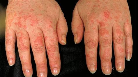 URTICARIA: CLASSIFICATION AND CAUSES