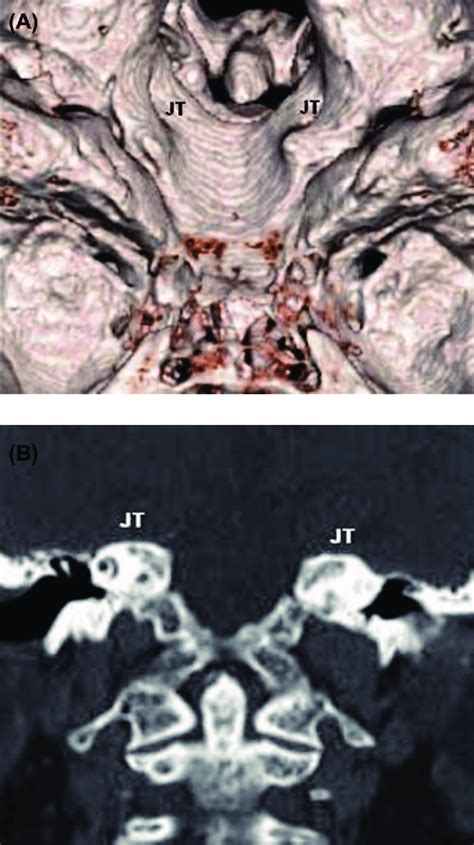 (A) A 3D CT reconstruction scan demonstrating unusual asymmetry of the... | Download Scientific ...