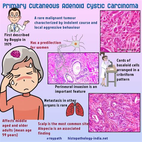 Cutaneous Adenoid Cystic Carcinoma | Pathology, Cancer, Malignant tumor