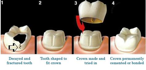 Dental crowns and bridges - Dentistry with Care Chatswood