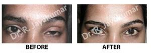 Ptosis Surgery Cost Kochi | Droopy Eyelid Surgery Kerala