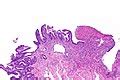 Gastric ulcer - Libre Pathology