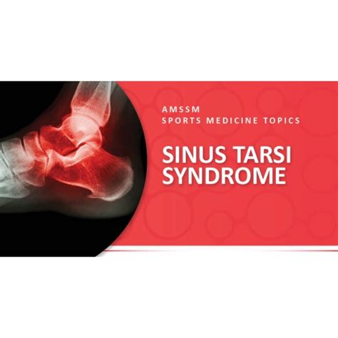 SINUS TARSI SYNDROME | Sports Medicine Today