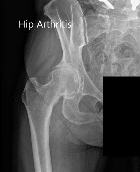 Case Study: Right Hip Arthritis with Robotic Replacement