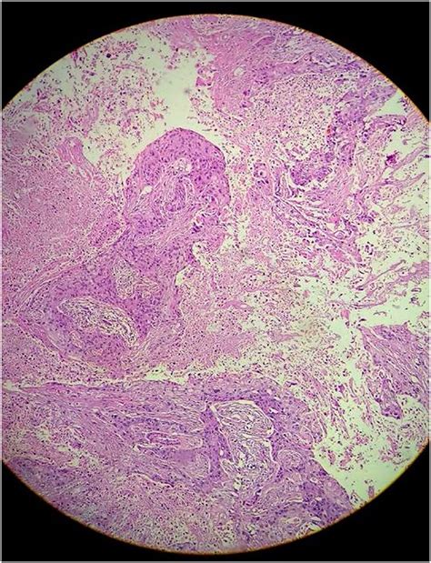 Histology of choledochal cyst showing atypical squamous cell arranged... | Download Scientific ...