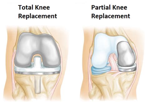 What is Knee Replacement Surgery And How To Prepare?