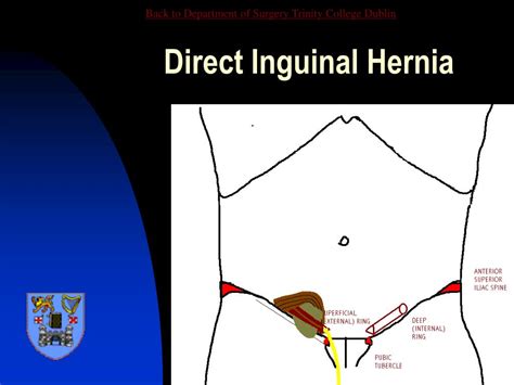 Diagram Of Groin Area Inguinal Hernias For Parents Nemours Kidshealth ...