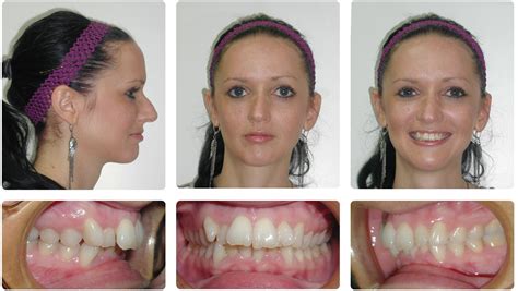 Overbite Surgery Before And After Pictures