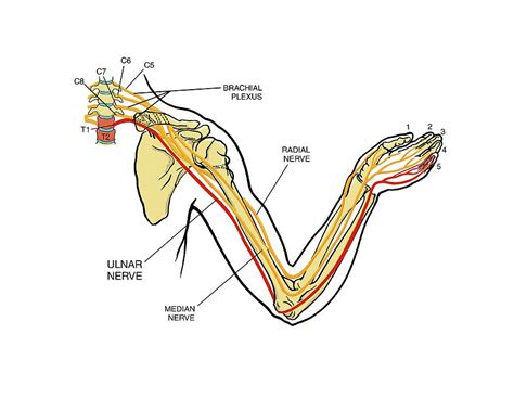 Brachial Plexus Arm Nerve Injury Photograph by John T. Alesi