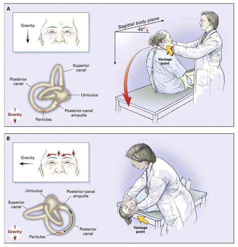 Hallpike Maneuver Illustration