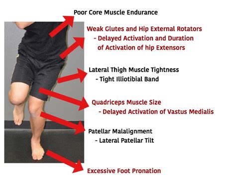 Patellofemoral pain syndrome - iconper