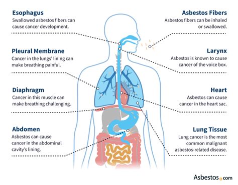 Asbestos Exposure: Health Risks, Symptoms & Prevention Tips