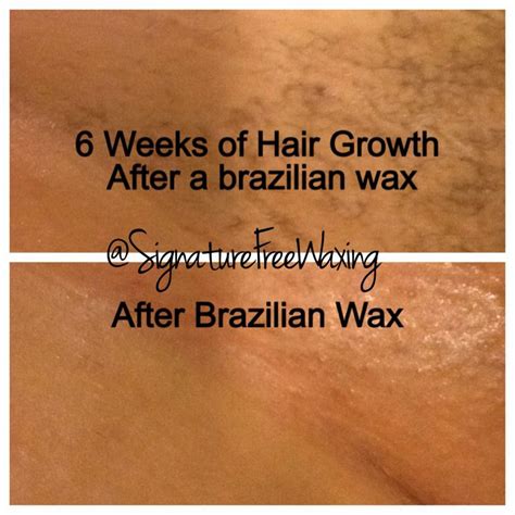 Top photo: 6 weeks after receiving a Brazilian wax at Signature Free ...