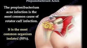 P Acnes Infection - Dr. Chakradhar