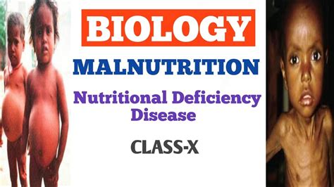 Malnutrition | Nutritional Deficiency Diseases : Nutrition | Biology ...