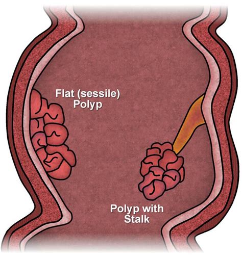 Pin on The Best Colonoscopy Los Angeles