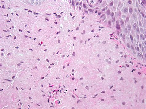 Granular Cell Tumor Histology