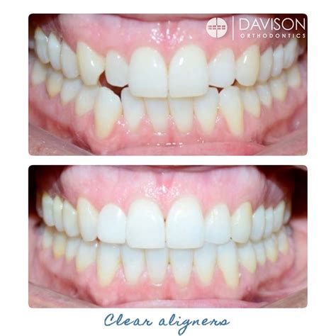 Clear Aligners - Davison Orthodontics