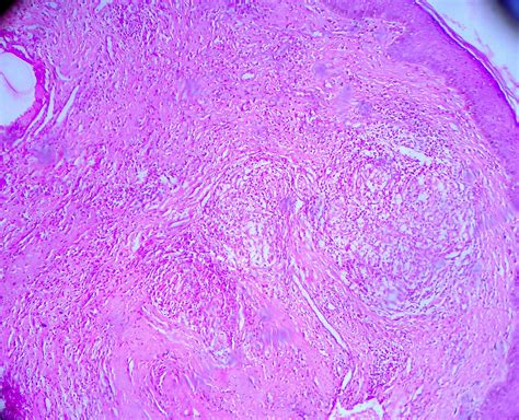 Cheilitis granulomatosa (Miescher granulomatous macrocheilitis) with trisomy 21