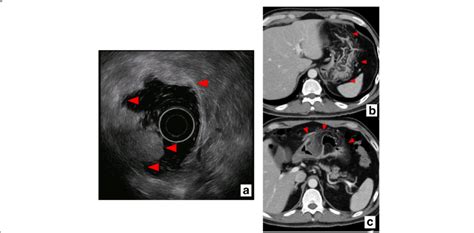 Findings on EUS and CT. EUS (a) and CT (b, c) findings are shown. EUS ...