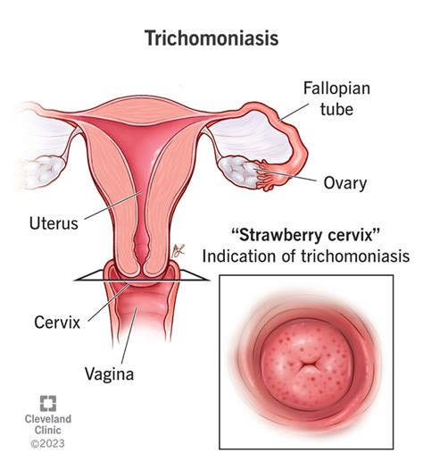 Trichomoniasis: Causes, Symptoms, Testing & Treatment