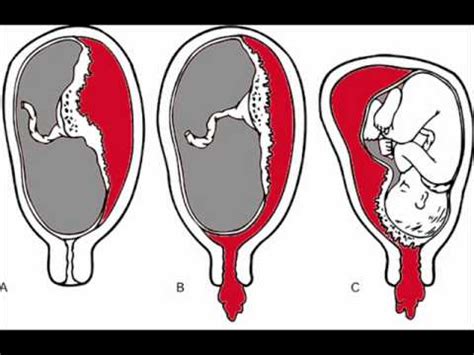 amudu: What is Antepartum Haemorrhage (APH)