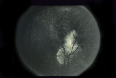 Paracentral Blind Spot And Scotoma - Retina Image Bank