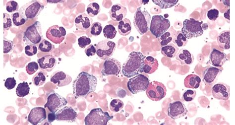 Transformation of the treatment of CML