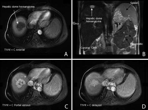 A-D. MRI shows (A) T1 hypointense and (B) T2 hyperintense hepatic dome... | Download Scientific ...