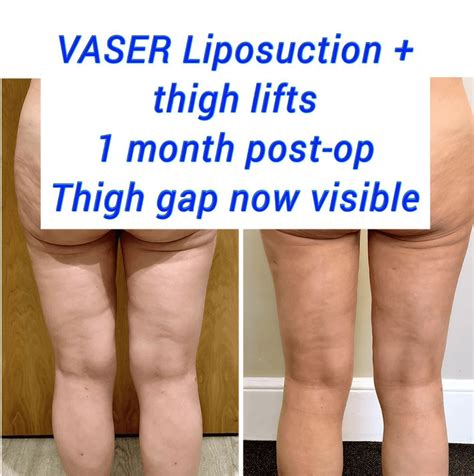 Loose Skin On Inner Thighs After Weight Loss Sale | fabricadascasas.com