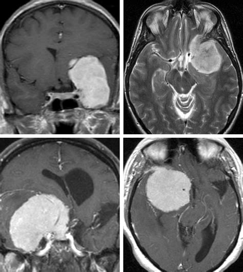 Medial Sphenoid Wing Meningioma | The Neurosurgical Atlas, by Aaron Cohen-Gadol, M.D.