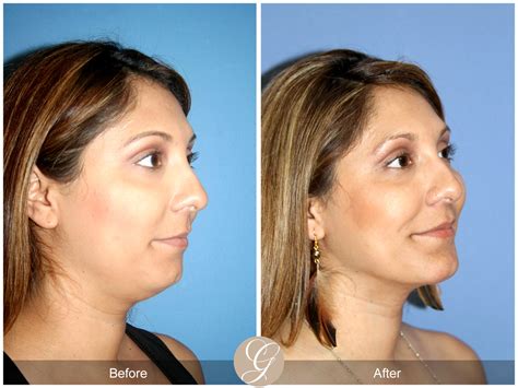 Neck Liposuction, Chin Augmentation 27 Before After Photos Orange County