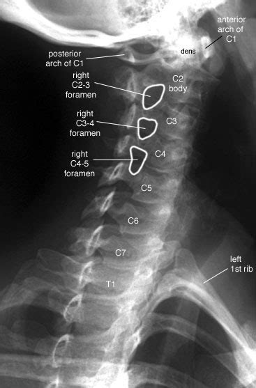 Radiographic Anatomy of the Skeleton: Cervical Spine -- Right Anterior ...