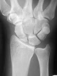 Scaphoid Fracture - Hand - Orthobullets