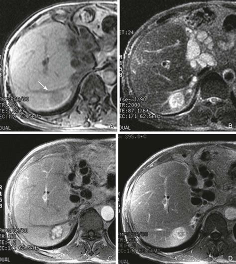 Benign Tumors of the Liver | Radiology Key