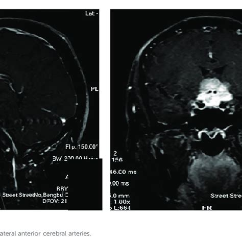 Characteristics of patients with tuberculum sellae meningioma (TSM ...