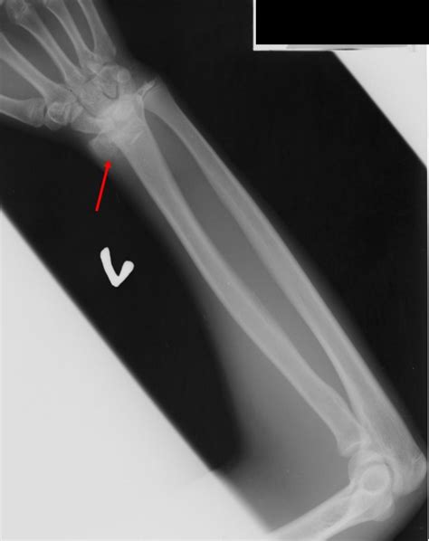 Salter-Harris fracture Type I – Radiology Cases