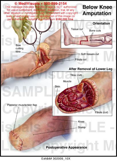 Below Knee Amputation Anatomy