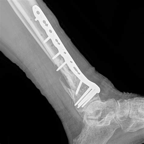 Lower limb fractures