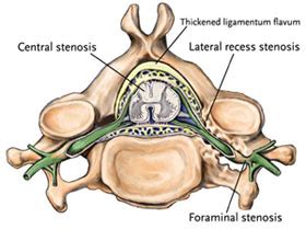 Foraminal Stenosis - AKSIS Special Hospital