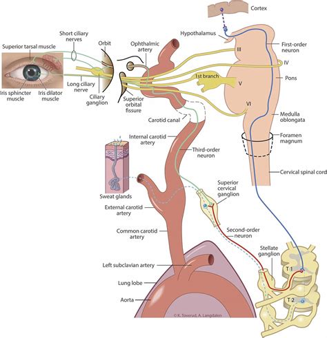 Horner's Syndrome - Causes, Signs & Symptoms, Diagnosis, Treatment