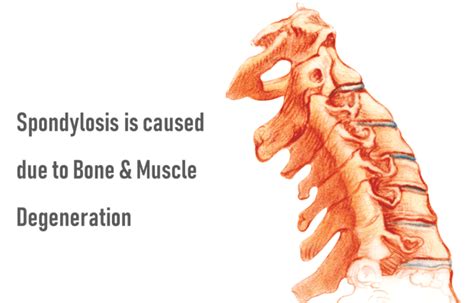 Spondylosis Treatment: Therapy, Symptoms & Causes | QI Spine