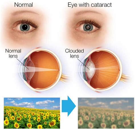 What Are The Symptoms of Cataracts? — iCare Family Vision