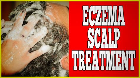 Eczema Scalp Treatment - 3 Shocking Eczema Scalp Treatment - YouTube