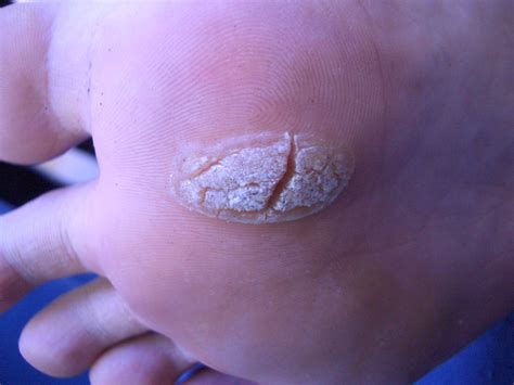 Plantar Warts Removal | 🩺Singapore Sports & Orthopaedic Surgeon