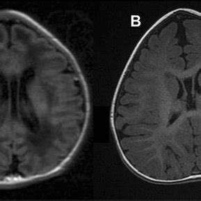 Patient 5 MRI scan showing a cavum septum pellucidum (a). Patient 6 MRI ...