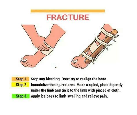 Fracture | First aid steps, Fracture, First aid tips