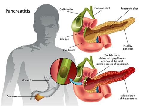 Pancreatitis: Symptoms, Complications and Treatment