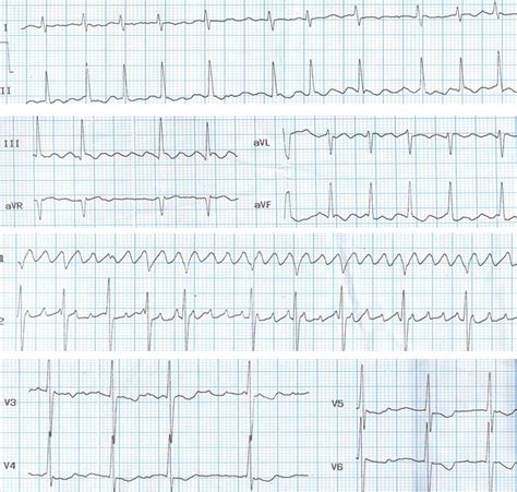 Atrial flutter in mitral stenosis – All About Cardiovascular System and ...