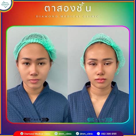 ตาสองชั้น ยกหางหงษ์ 👁 Black Swan Eyes Surgery หรือ ทำตาสองชั้น ยกหางหงส์ อีกหนึ่งศัลยกรรมตา ...